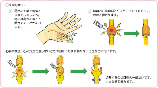 治療 ばね指