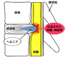 ヘルニア 治癒 頚椎 自然 頚椎（頸椎）椎間板ヘルニアは完治しない？ 専門医に聞く頚椎ヘルニアの検査と治療