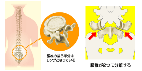 症 腰椎 すべり