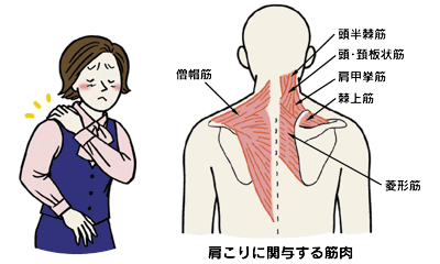 肩こり 日本整形外科学会 症状 病気をしらべる