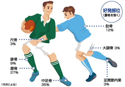 疲労骨折 日本整形外科学会 症状 病気をしらべる