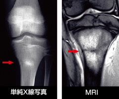 疲労 骨折 と は