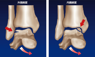 距骨骨軟骨損傷の外側病変と内側病変